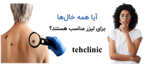 آیا همه خال‌ها برای لیزر مناسب هستند؟