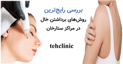 بررسی رایج‌ترین روش‌های برداشتن خال در مراکز ستارخان