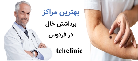 بهترین مراکز برداشتن خال در فردوس