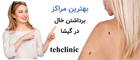 بهترین مراکز برداشتن خال در گیشا