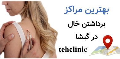 بهترین مراکز برداشتن خال گیشا