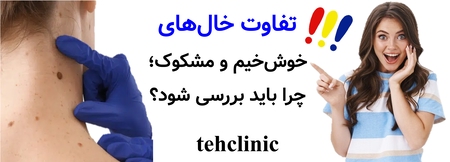 تفاوت خال‌های خوش‌خیم و مشکوک؛ چرا باید بررسی شود؟