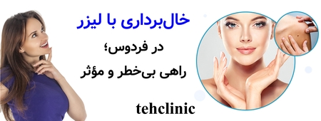 خال‌برداری با لیزر در فردوس؛ راهی بی‌خطر و مؤثر