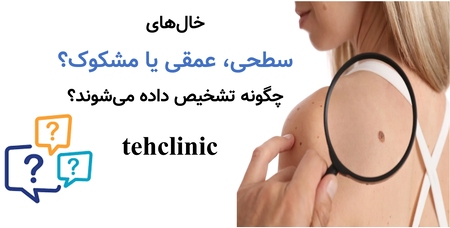 خال‌های سطحی، عمقی یا مشکوک؟ چگونه تشخیص داده می‌شوند؟