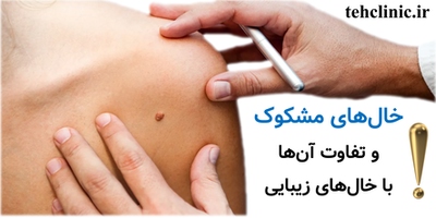 خال‌های مشکوک و تفاوت آن‌ها با خال‌های زیبایی