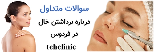 سوالات متداول درباره برداشتن خال در فردوس