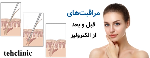 مراقبت‌های قبل و بعد از الکترولیز