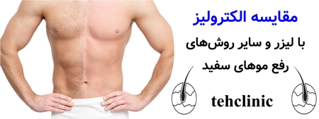مقایسه الکترولیز با لیزر و سایر روش‌های رفع موهای سفید