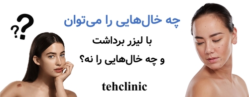 چه خال‌هایی را می‌توان با لیزر برداشت و چه خال‌هایی را نه؟