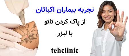 تجربه بیماران اکباتان از پاک کردن تاتو با لیزر