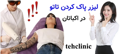 لیزر پاک کردن تاتو در اکباتان
