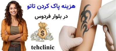 هزینه پاک کردن تاتو در بلوار فردوس