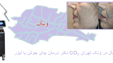 از بین بردن جوش با لیزر فرکشنال در ونک