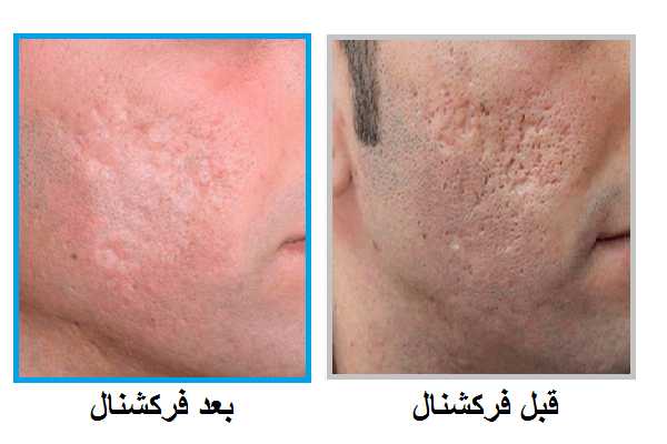 عکس قبل و بعد لیزر CO₂ فرکشنال شهرک غرب