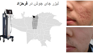 فرحزاد لیرز جوش