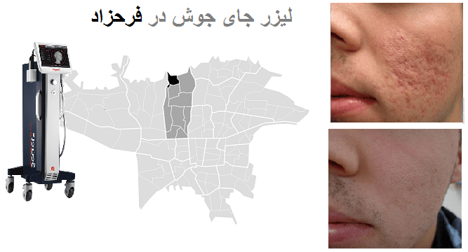 فرحزاد لیرز جوش