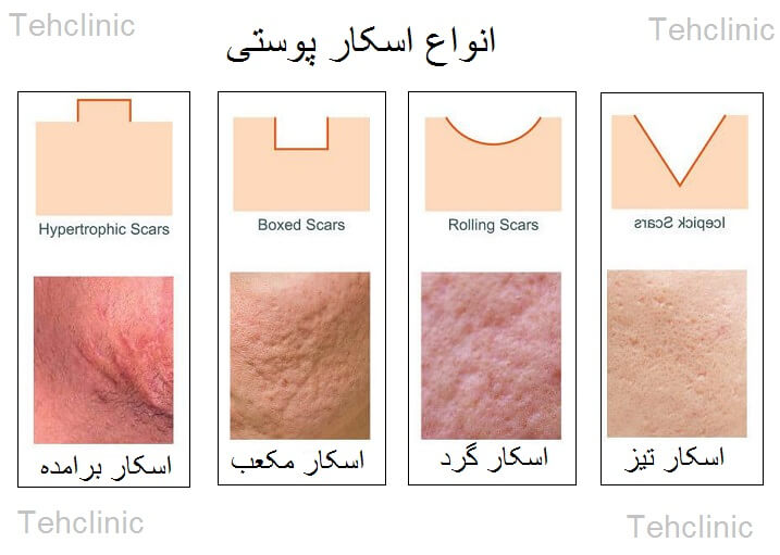  انواع اسکار rolling, boxcar, icepick