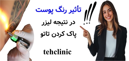 تأثیر رنگ پوست در نتیجه لیزر پاک کردن تاتو