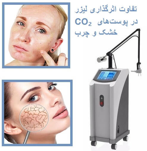 تفاوت اثرگذاری لیزر CO₂ در پوست‌های خشک و چرب
