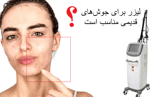 آیا لیزر CO₂ فرکشنال برای جای جوش‌های قدیمی مناسب است؟