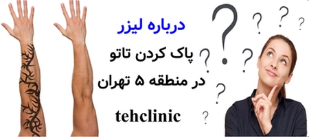 درباره لیزر پاک کردن تاتو در منطقه ۵ تهران