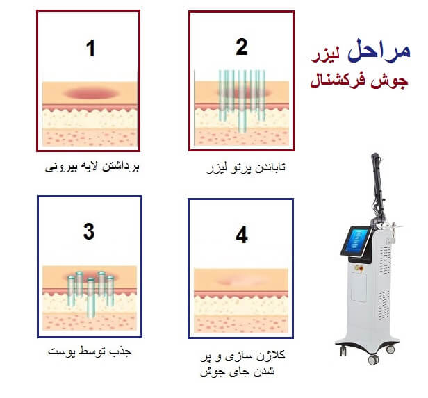 لیزر CO₂ چگونه لایه‌های آسیب‌دیده پوست را بازسازی می‌کند؟