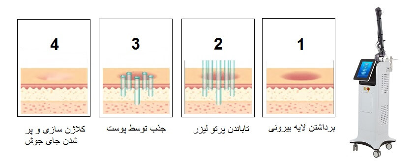 عملکرد لیزر CO₂ فرکشنال در ترمیم جای جوش
