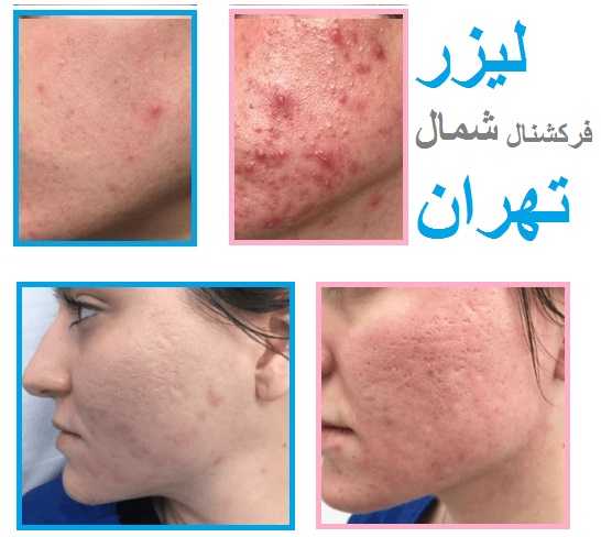 نمونه عکس های لیزر CO₂ فرکشنال قبل و بعد