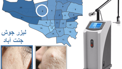 لیزر جوش فرشکنال جنت آباد