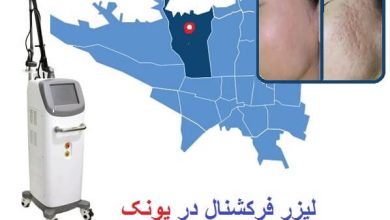 لیزر جوش فرکشنال CO2 پونک