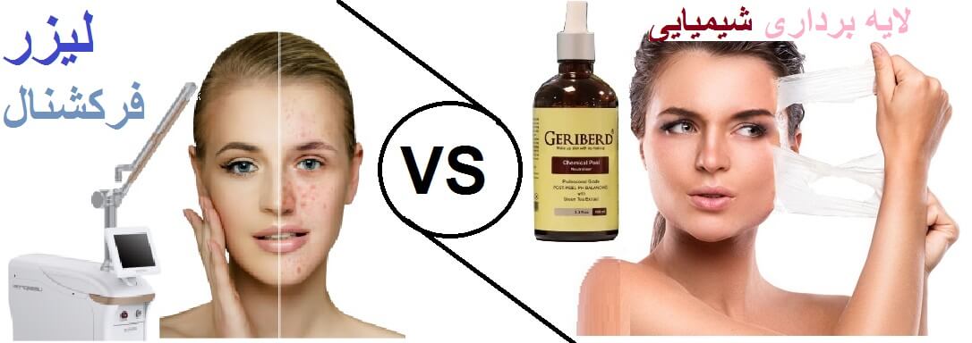 تفاوت اثر لیزر در درمان جای جوش با لایه‌برداری شیمیایی