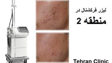 لیزر فرکشنال جوش منطقه 2 تهران