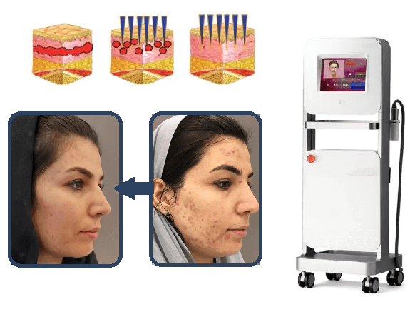 تفاوت عمق نفوذ لیزر در جای جوش‌های سطحی و عمیق