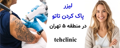 لیزر پاک کردن تاتو در منطقه ۵ تهران
