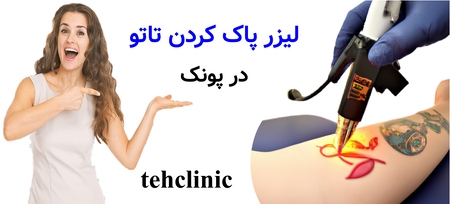 لیزر پاک کردن تاتو در پونک