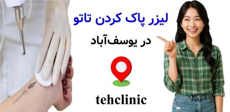 لیزر پاک کردن تاتو در یوسف‌آباد