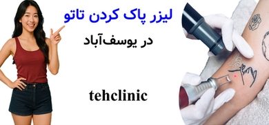 لیزر پاک کردن تاتو یوسف‌آباد