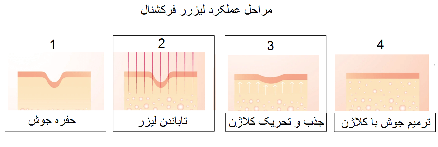مراحل عملکرد لیزر جوش فرکشنال