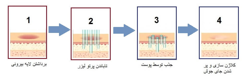 نحوه بازسازی طبیعی پوست بعد از هر جلسه لیزر