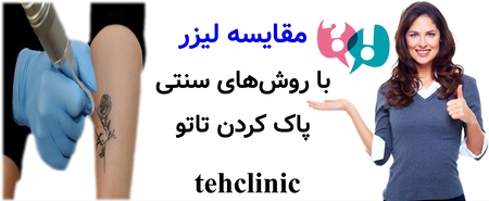 مقایسه لیزر با روش‌های سنتی پاک کردن تاتو