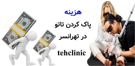 هزینه پاک کردن تاتو در تهرانسر