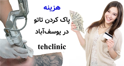 هزینه پاک کردن تاتو در یوسف‌آباد