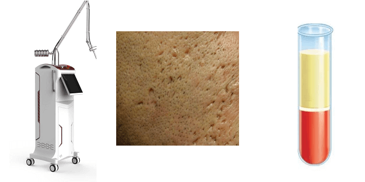 ترکیب لیزر CO₂ با درمان PRP برای اسکارهای عمیق