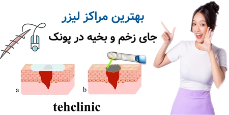 بهترین مراکز لیزر جای زخم و بخیه در پونک