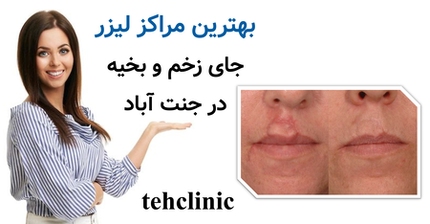 بهترین مراکز لیزر جای زخم و بخیه در جنت آباد
