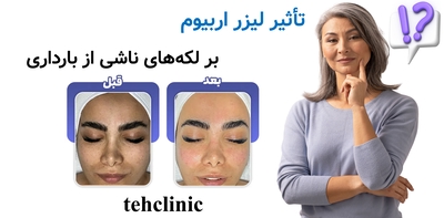 تأثیر لیزر اربیوم بر لکه‌های ناشی از بارداری