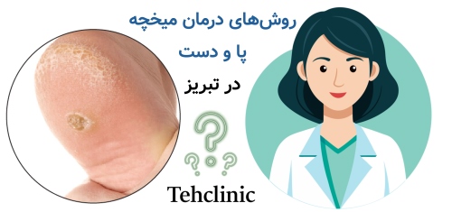 مراکز درمان میخچه پا و دست در تبریز | راهنمای انتخاب مرکز تخصصی روشهای درمان میخچه پا و دست در تبریز