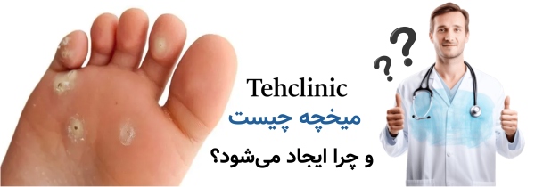 مراکز درمان میخچه پا و دست در تبریز | راهنمای انتخاب مرکز تخصصی میخچه چیست و چرا ایجاد میشود؟