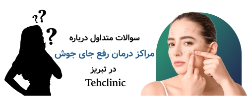 سوالات متداول درباره مراکز درمان رفع جای جوش در تبریز