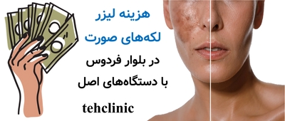 هزینه لیزر لکه‌های صورت در بلوار فردوس با دستگاه‌های اصل